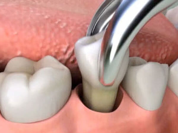 Tooth Extraction